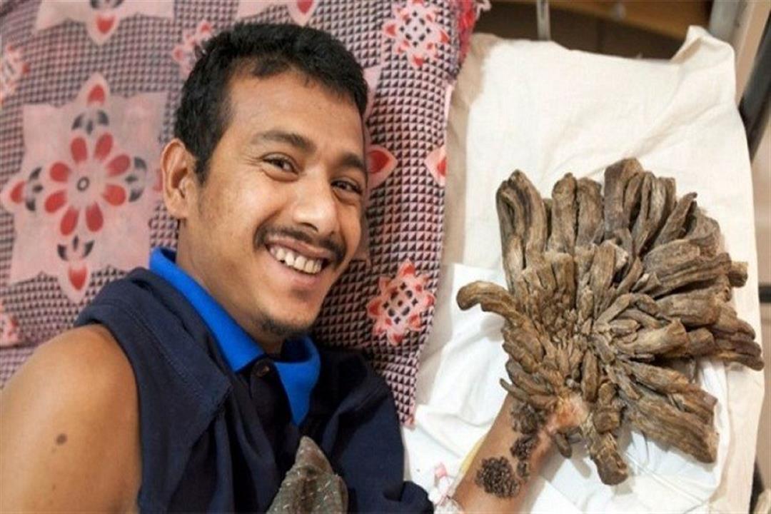 بعد خضوعه لـ25 عملية.. رجل يقرر قطع يديه لهذا السبب