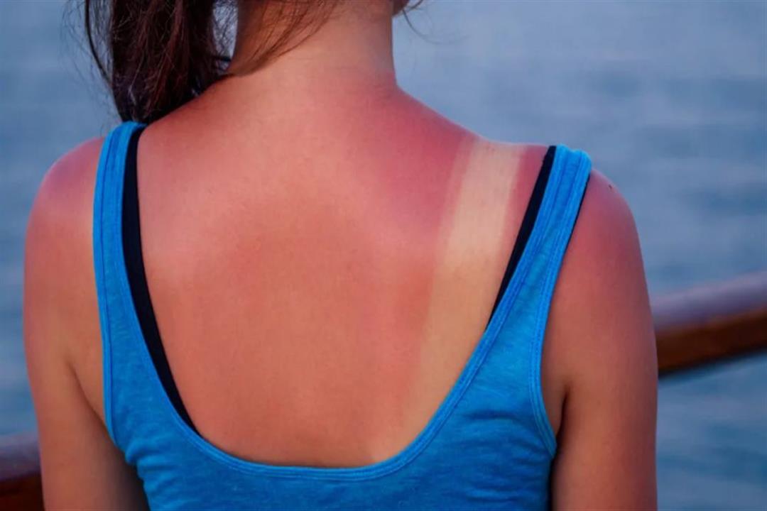 مخاطر متعددة لحروق الشمس في المصيف.. إليك طرق الوقاية والعلاج