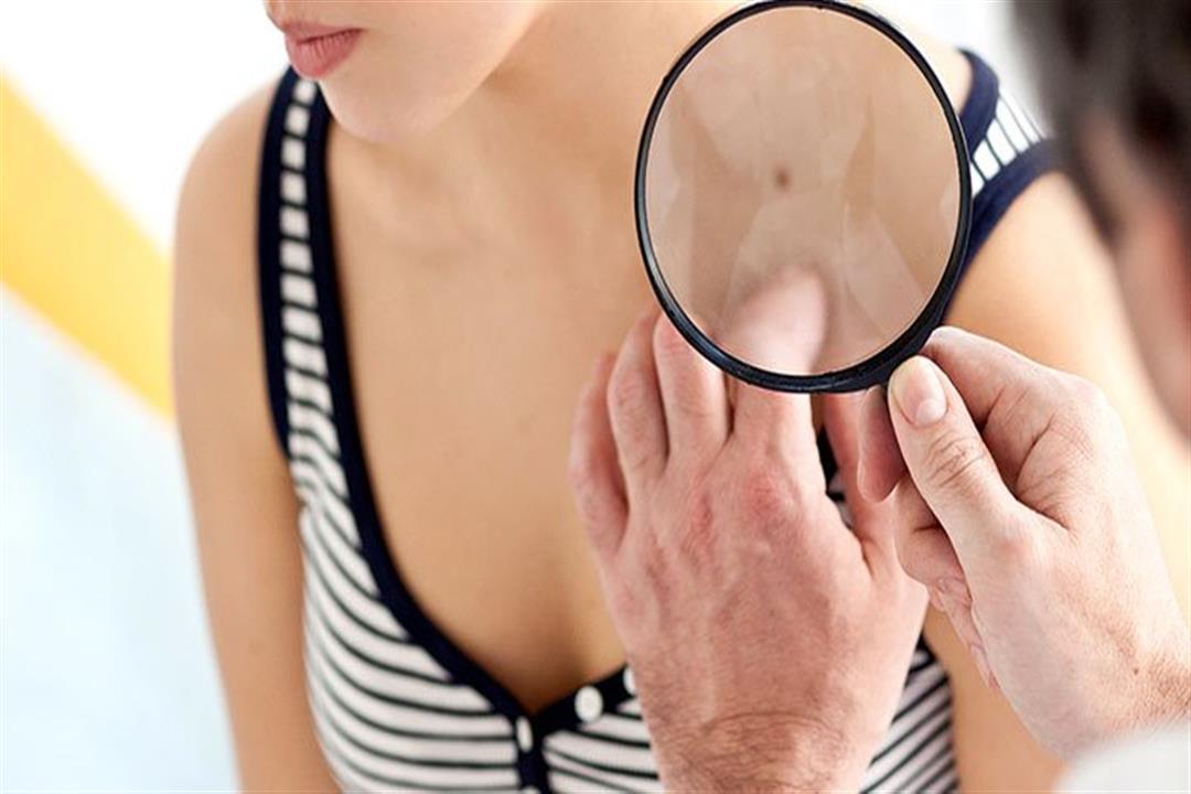 قد يؤدي للوفاة.. إليك كيفية اكتشاف الإصابة بسرطان الجلد 