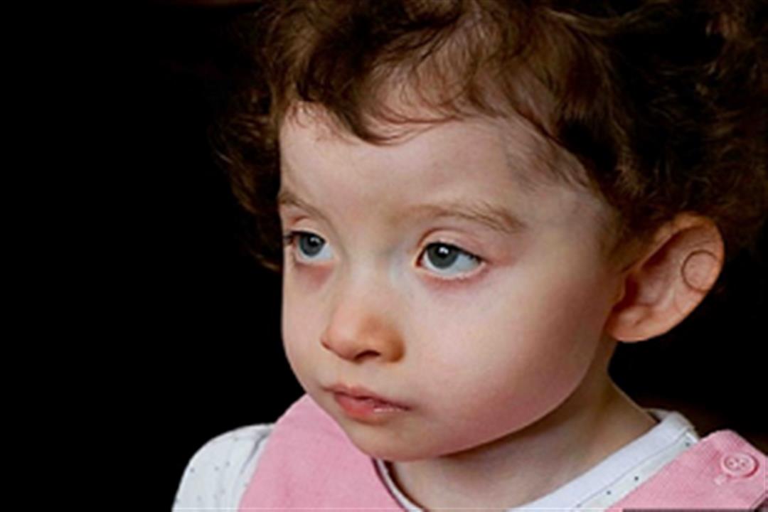  إصابة طفلة باضطراب يمنعها من الكلام.. تعرف على أعراض مرضها النادر
