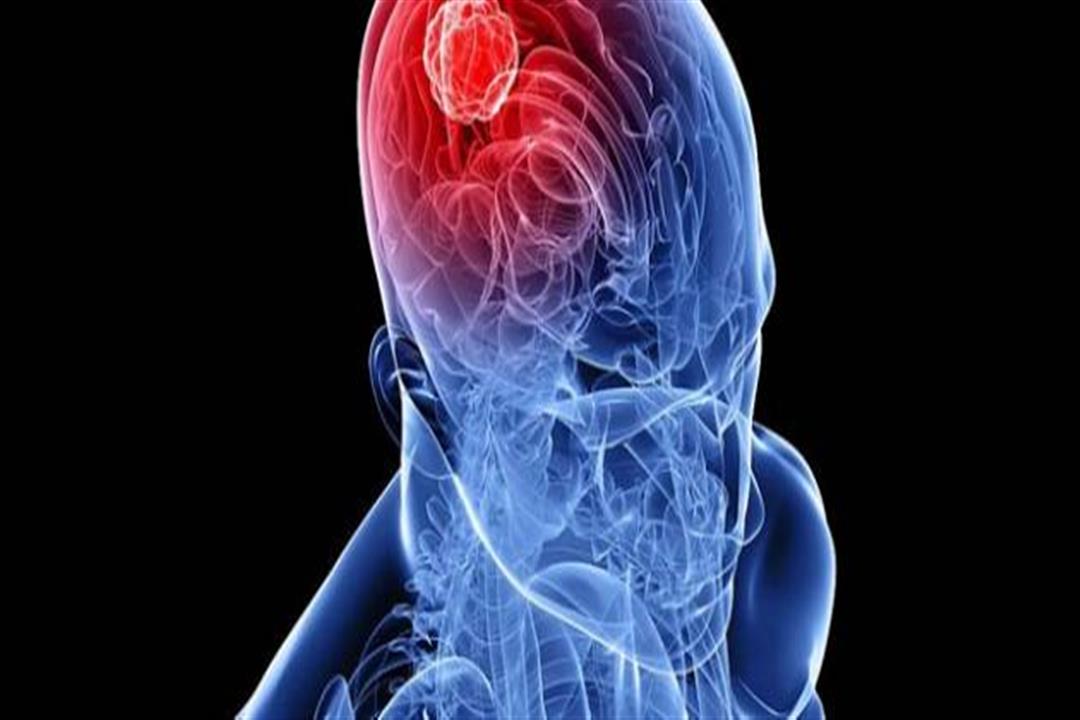 أعراض سرطان المخ- متى يجب التوجه للطبيب؟