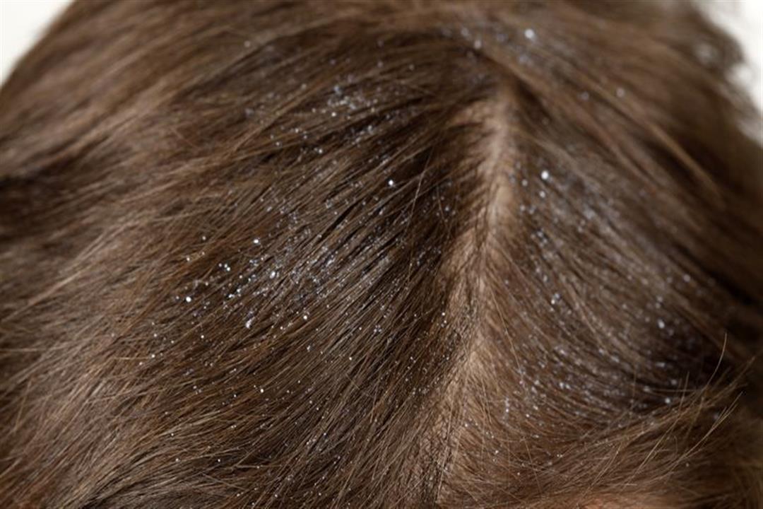 dandruff-royalty-free-image-118055850-1539027790