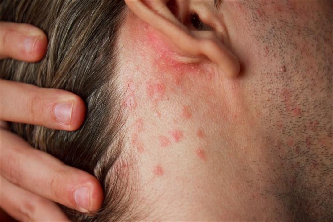 rash-royalty-free-image-173918140-1539030012