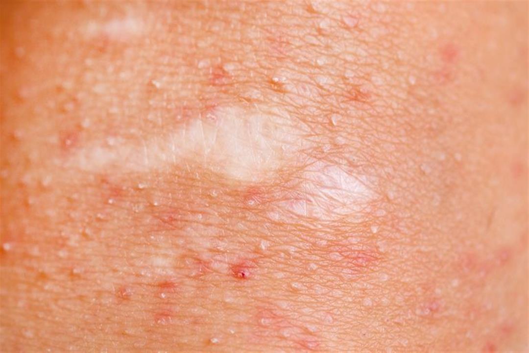 wound-on-female-knee-irritated-skin-royalty-free-image-841557586-1539030759