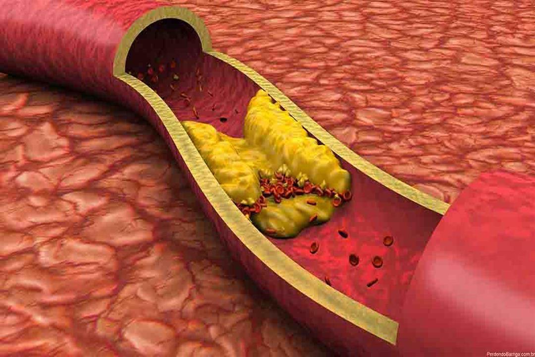 للوقاية من أمراض القلب.. 4 أطعمة تخفض الدهون الثلاثية في الدم