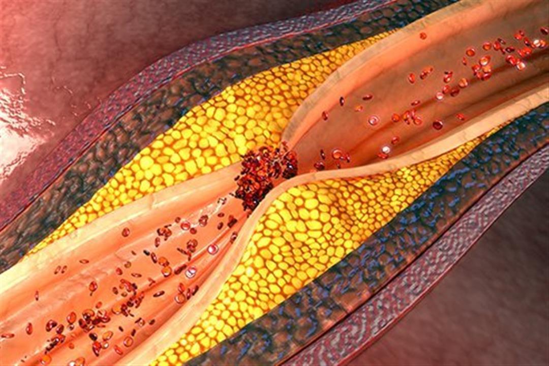 أعراض تكشف تعرضك لتصلب الشرايين.. إليك الأسباب وطرق العلاج