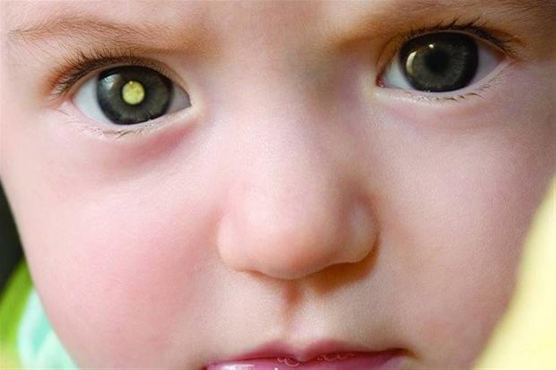 مرض كوتس يهدد طفلِك بالعمى.. 5 أعراض تكشف الإصابة به