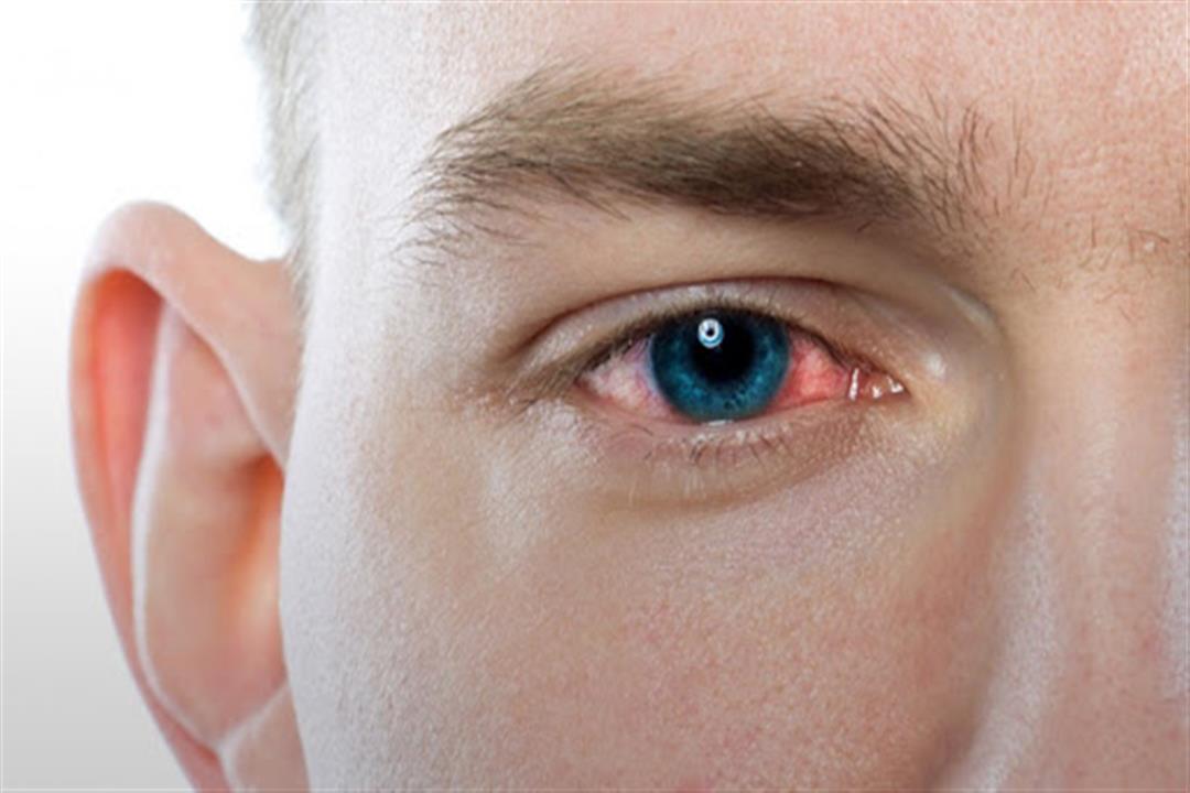 6 نصائح للوقاية من التهابات العين.. منها تنظيف شاشة الهاتف (صور)