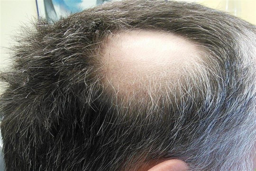 علماء يكشفون العلاقة بين تساقط الشعر وأمراض المناعة