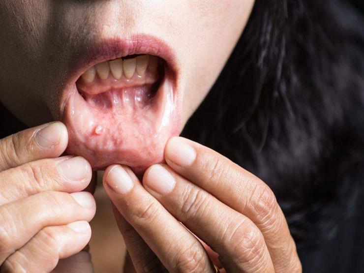 Beware … a strange mark in your mouth and teeth reveals that you have a serious disease