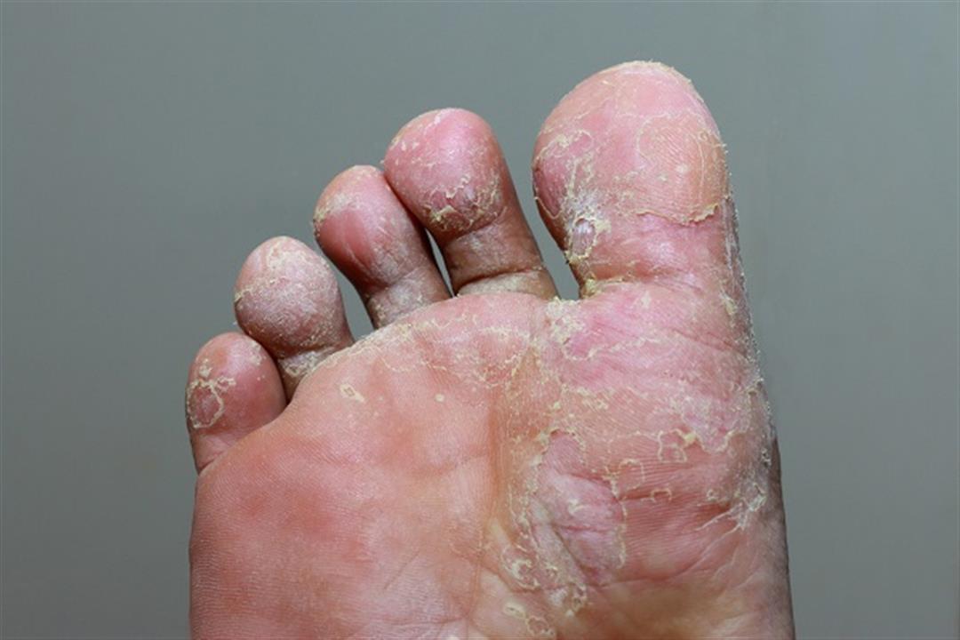 أعراضها مزعجة.. 5 طرق فعالة تحميك من الإصابة بفطريات القدم