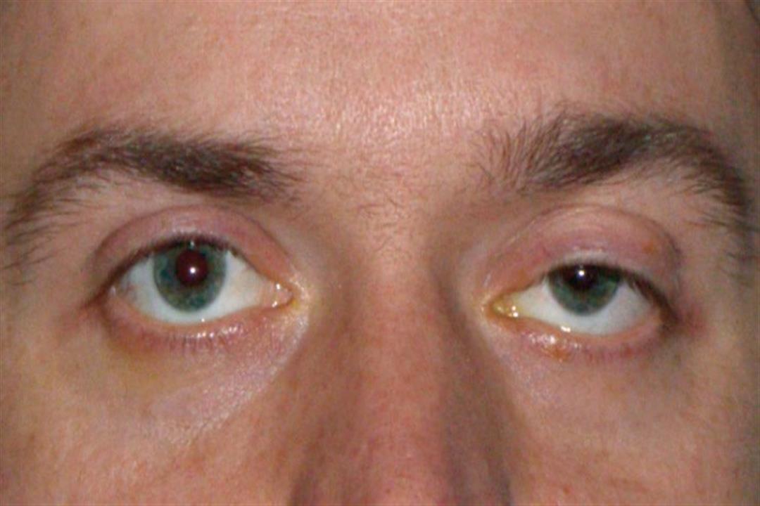 سقوط الجفن  2