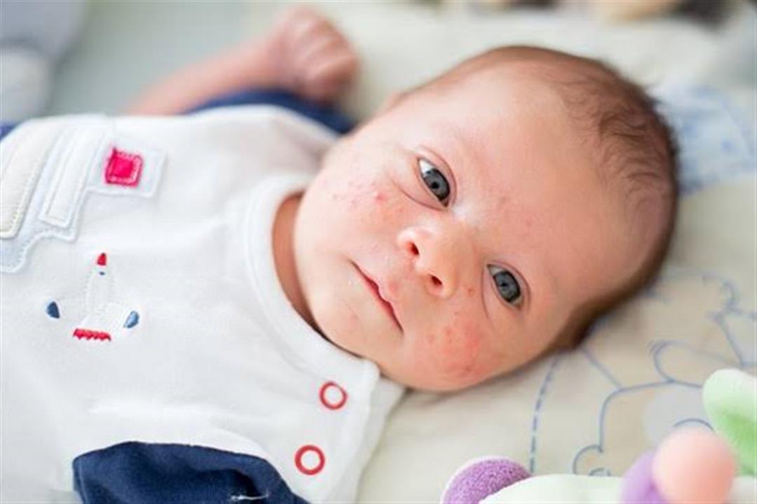 ما أسباب ظهور حبوب الوجه عند الأطفال والرضع؟.. إليك طرق العلاج