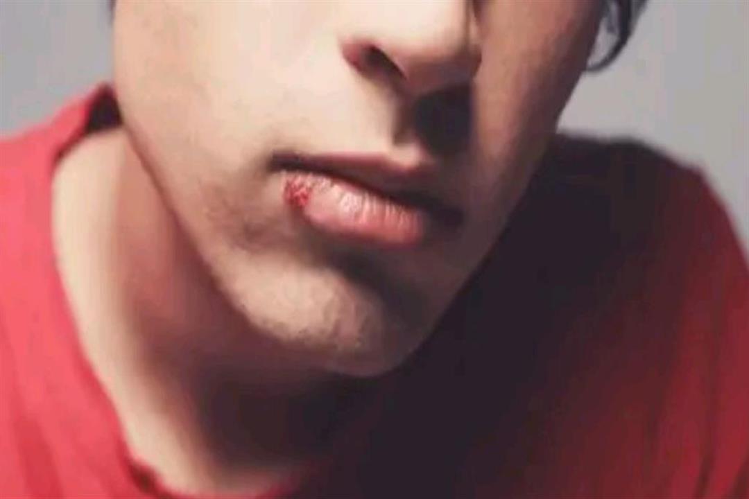 احذر لمس بثور الشفاه احذر لمس بثور الشفاه