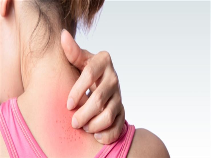 الطفح الجلدي أثناء الدورة الشهرية- هل السبب خطير؟