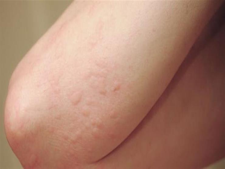 أطباء يكشفون أعراض جديدة لفيروس كورونا.. منها ألم الجلد والحكة