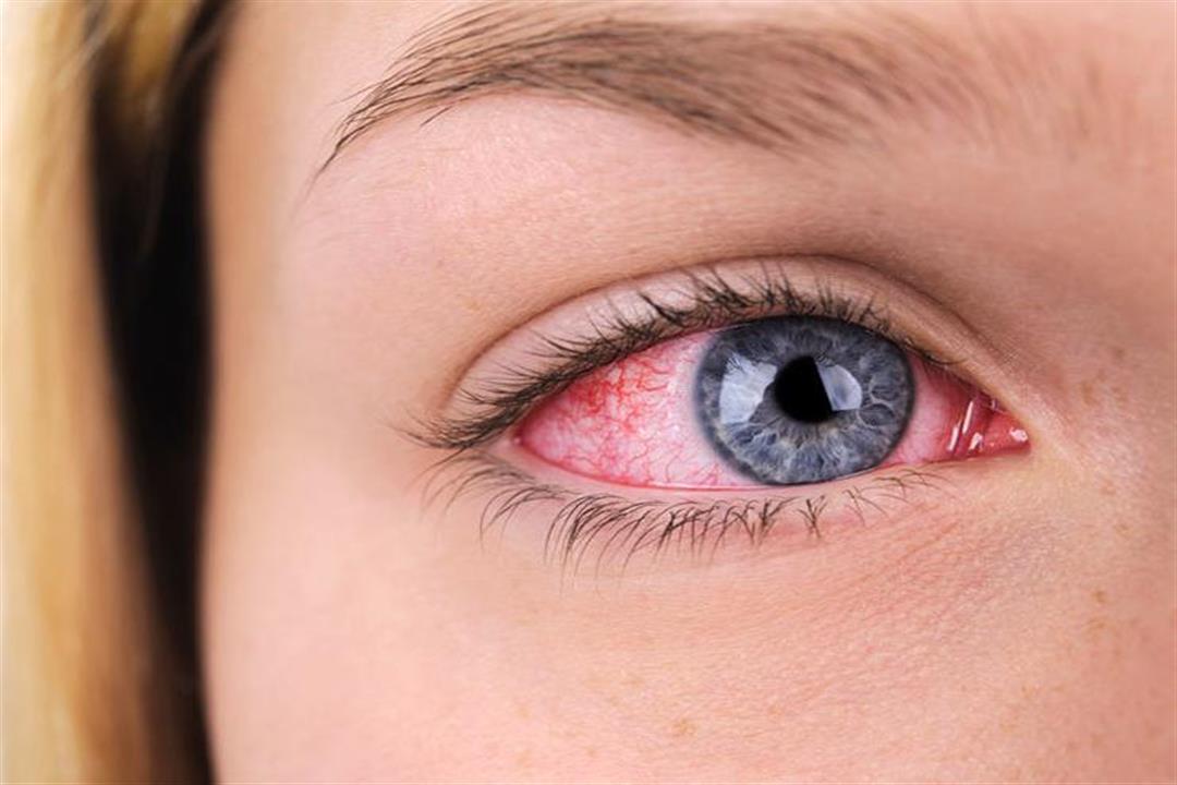 متى يؤدي جفاف العين إلى الإصابة بقرح القرنية؟
