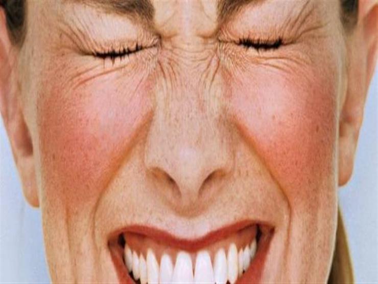 الوجه الأحمر