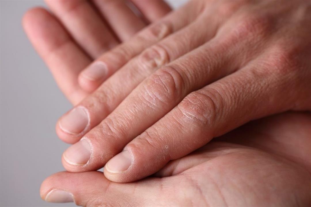 ينذر بالإصابة بسرطان الرئة.. 5 مراحل لحدوث "تعجر الأصابع"