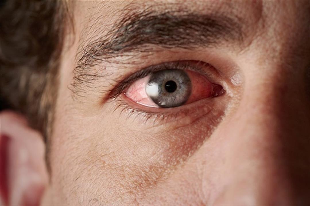 أبرزها الكمادات الباردة.. 6 طرق طبيعية لعلاج حساسية العين