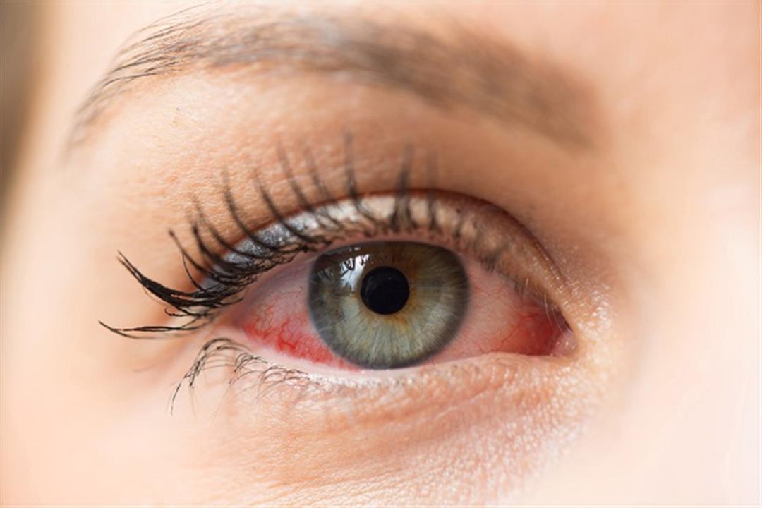 أعراضهما متشابهة.. طبيب يوضح الفرق بين جفاف وحساسية العين