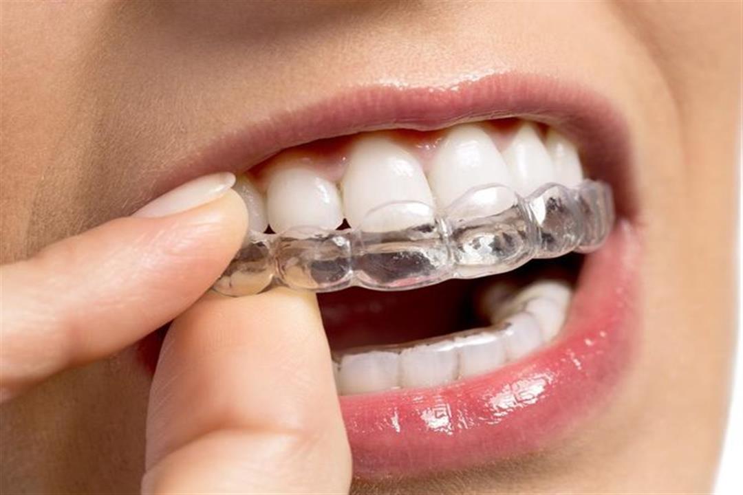 تبييض الأسنان