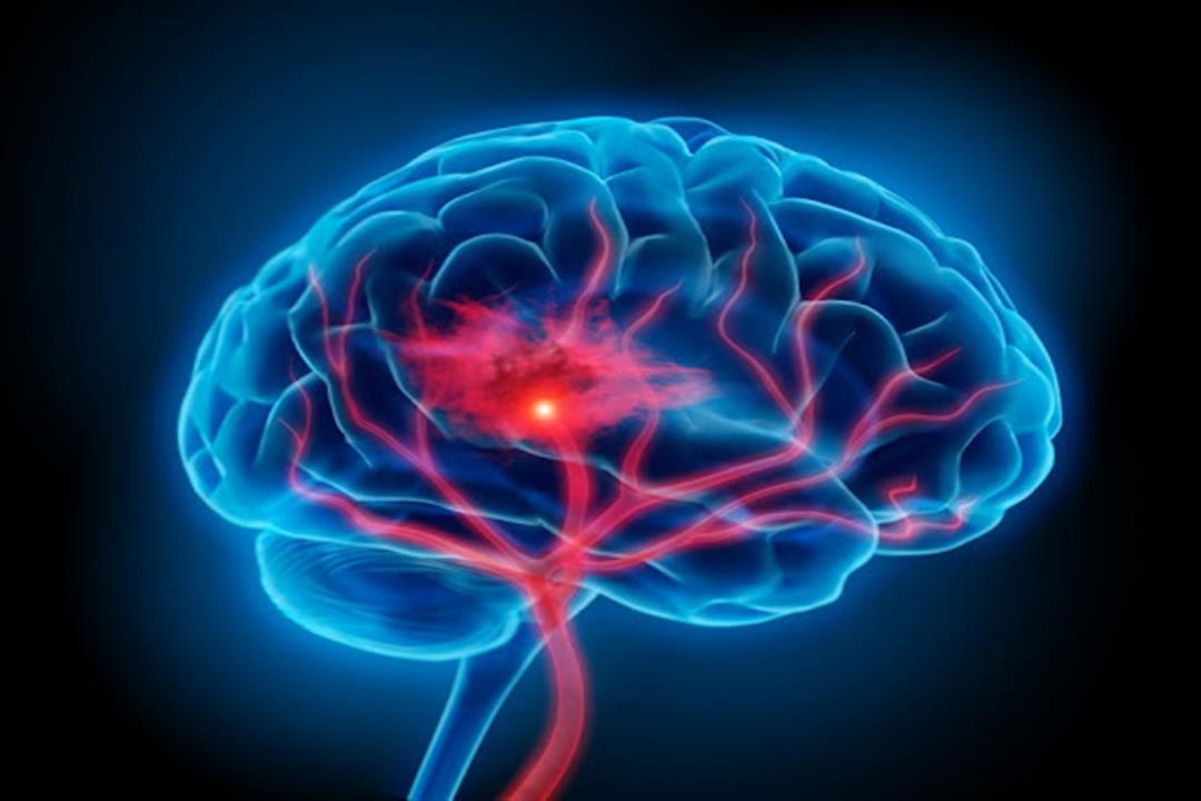 علامات أولية لنزيف المخ تعرف عليها
