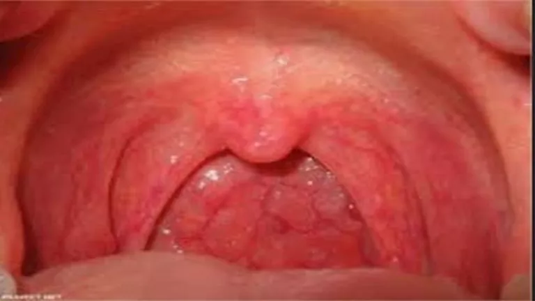 أعراض مبكرة تشير إلى سرطان الحلق تحتاج إلى انتباهك