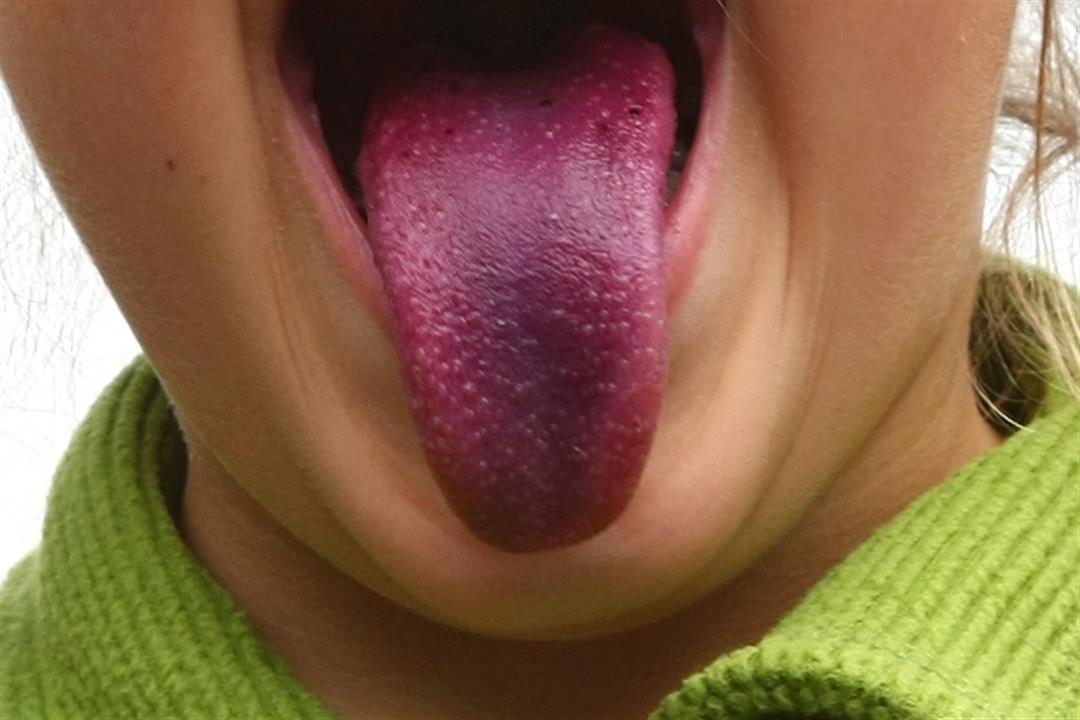 اللسان البنفسجي