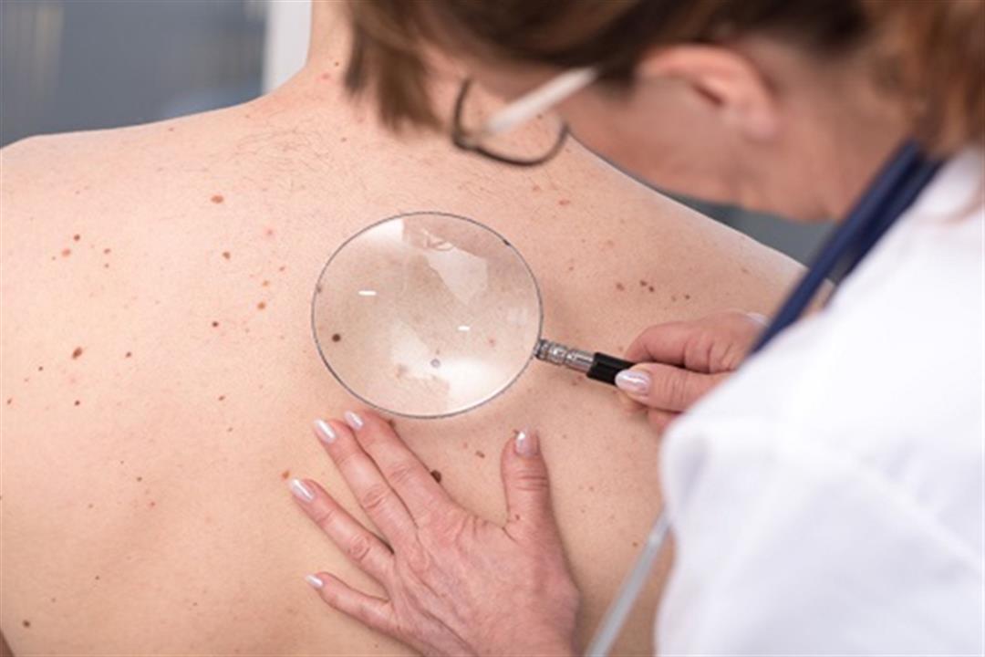 أخطر أنواع سرطتان الجلد- علامات تكشف إصابتك بالميلانوما