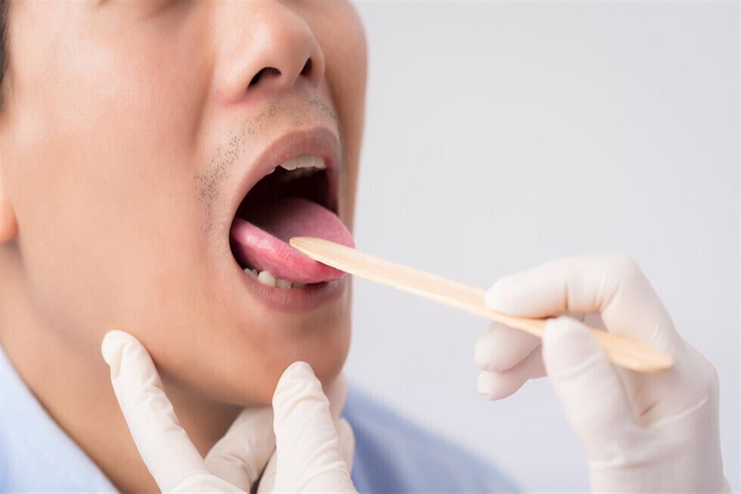 نتوءات اللسان.. متى تشير للإصابة بسرطان الفم؟