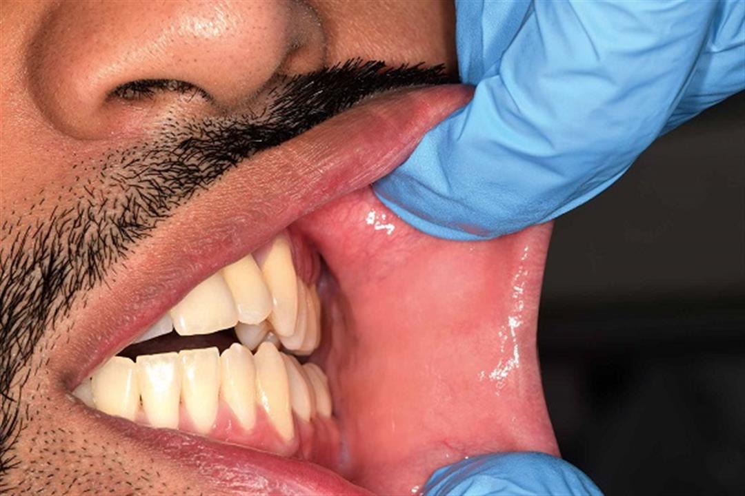 3 أعراض تكشف الإصابة بسرطان الفم