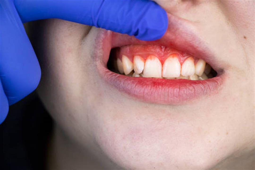 التهاب اللثة.. متى يستدعي زيارة طبيب الأسنان؟