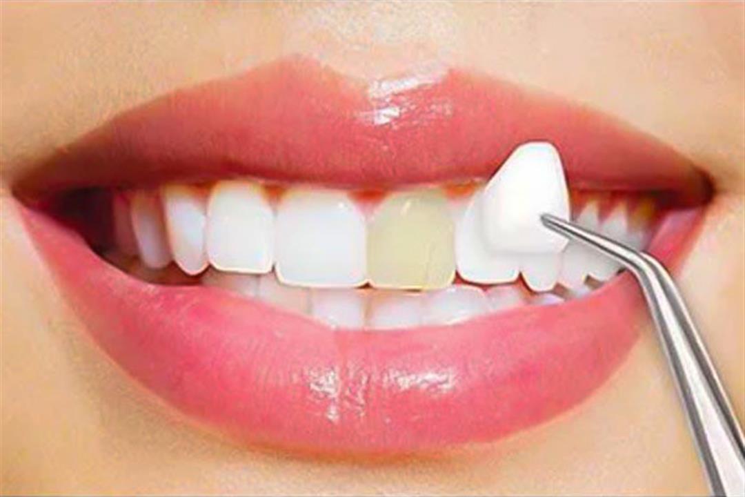 dental-veneers