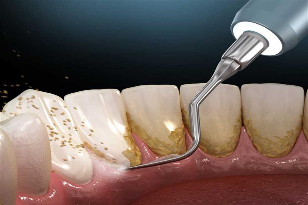 كيف تحمي فمّك من بلاك الأسنان؟
