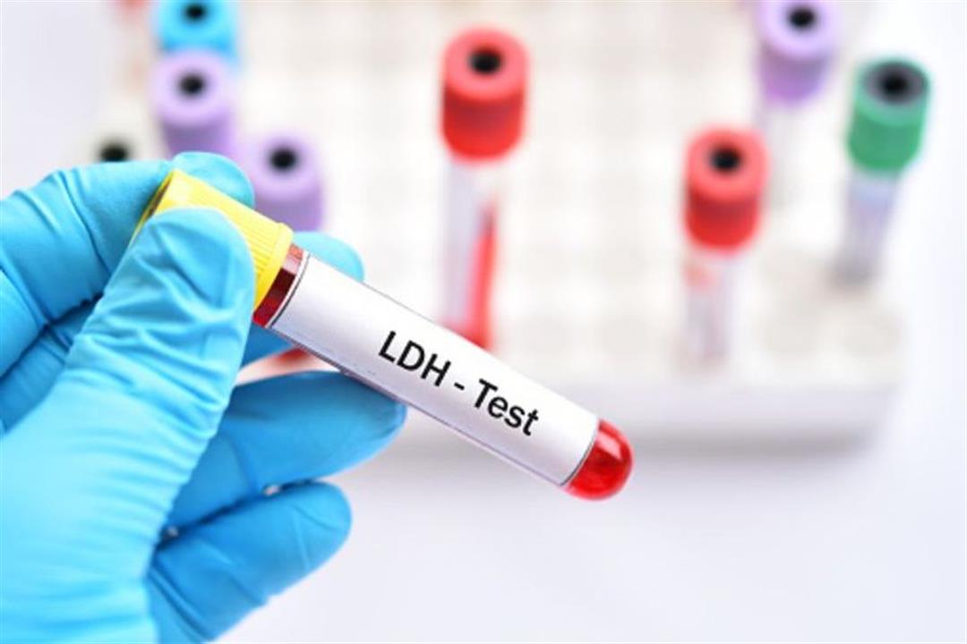 ما هو اختبار "LDH"؟.. كل ما تريد معرفته