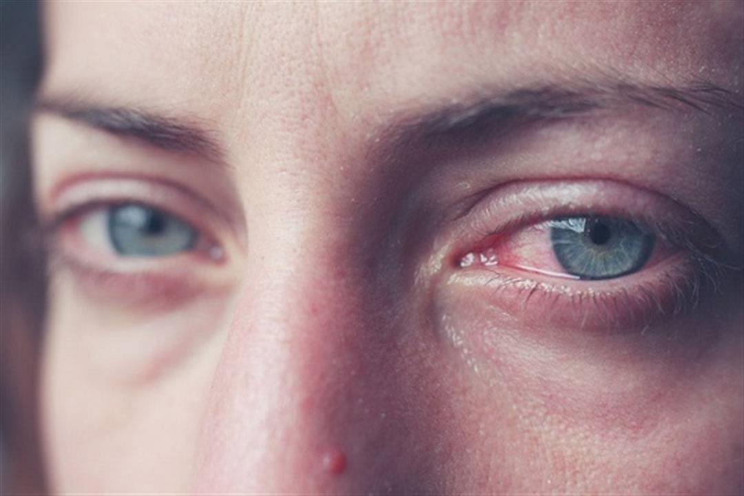 التهاب العين الفيروسي.. ما هي أعراضه وطرق علاجه؟