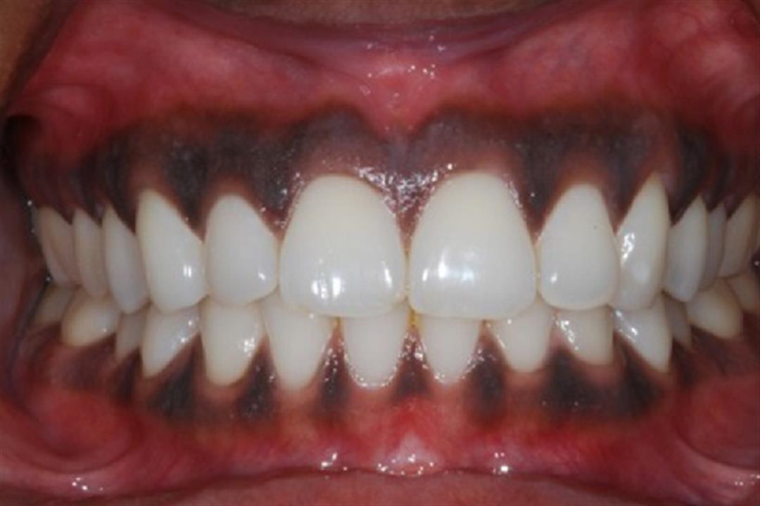 اللثة السوداء