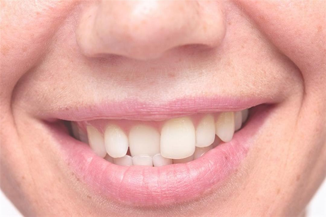 أسنانك الطويلة تفسد ابتسامتك؟.. 3 طرق للتغلب عليها