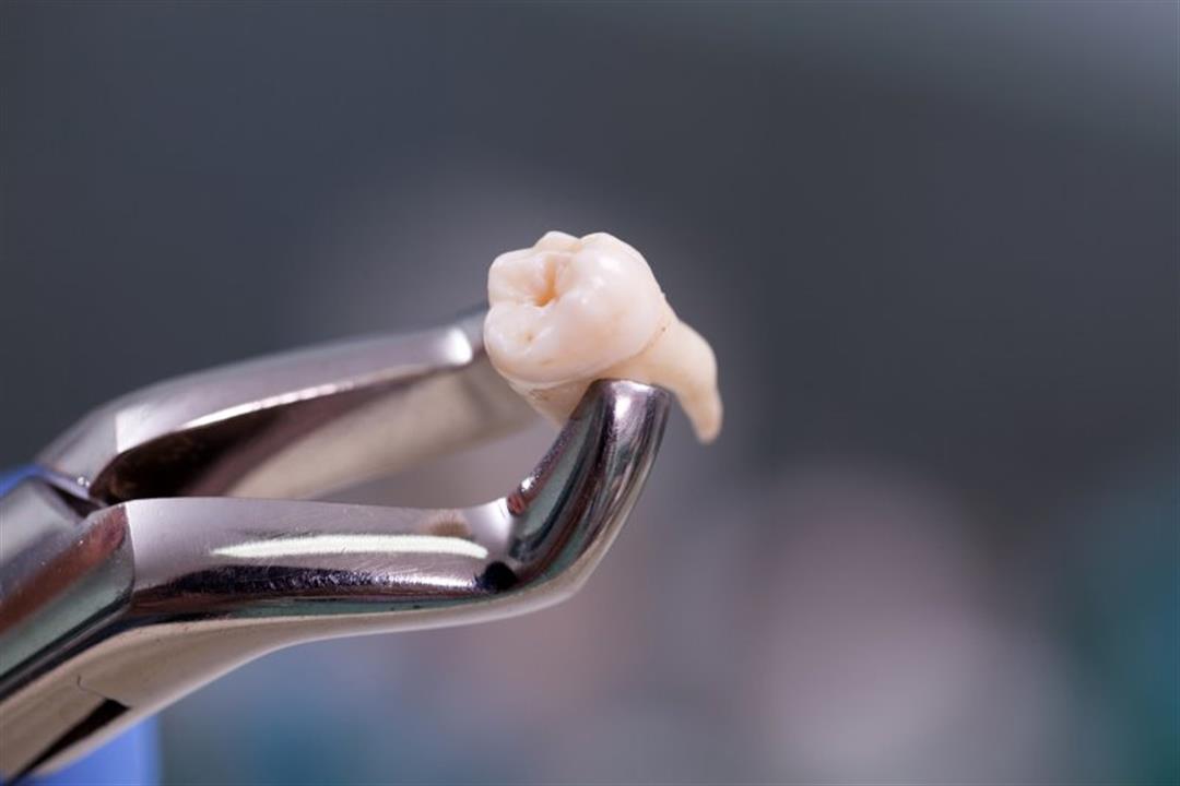 أبرزها 5 مشاكل تسوس الأسنان التي تتطلب إزالة الكونسولتو الضرس