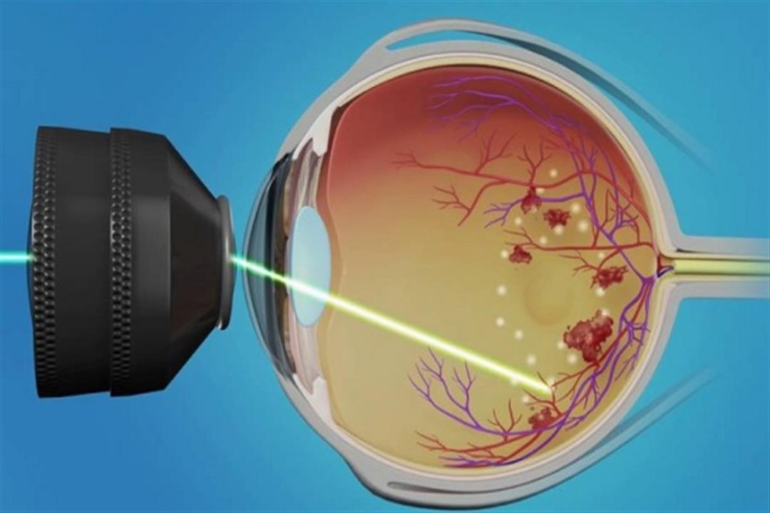 علاج ثقب الشبكية بالليزر