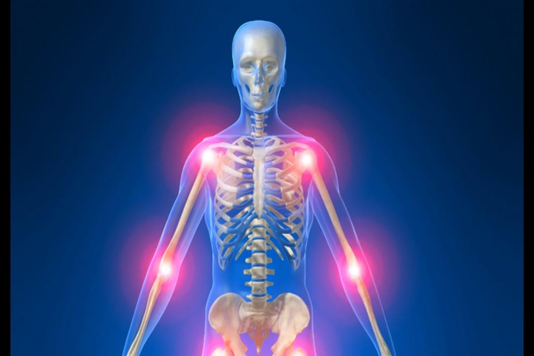مرض غريب يحول العضلات إلى عظام- ما هو؟