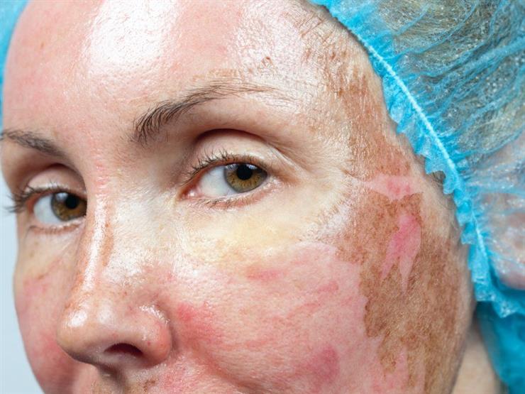 Fasi di peeling chimico per il viso con immagini