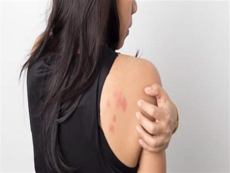 الطفح الجلدي يضرب 74% من مصابي كورونا.. انتبه للعلامات الجلد | مصراوى