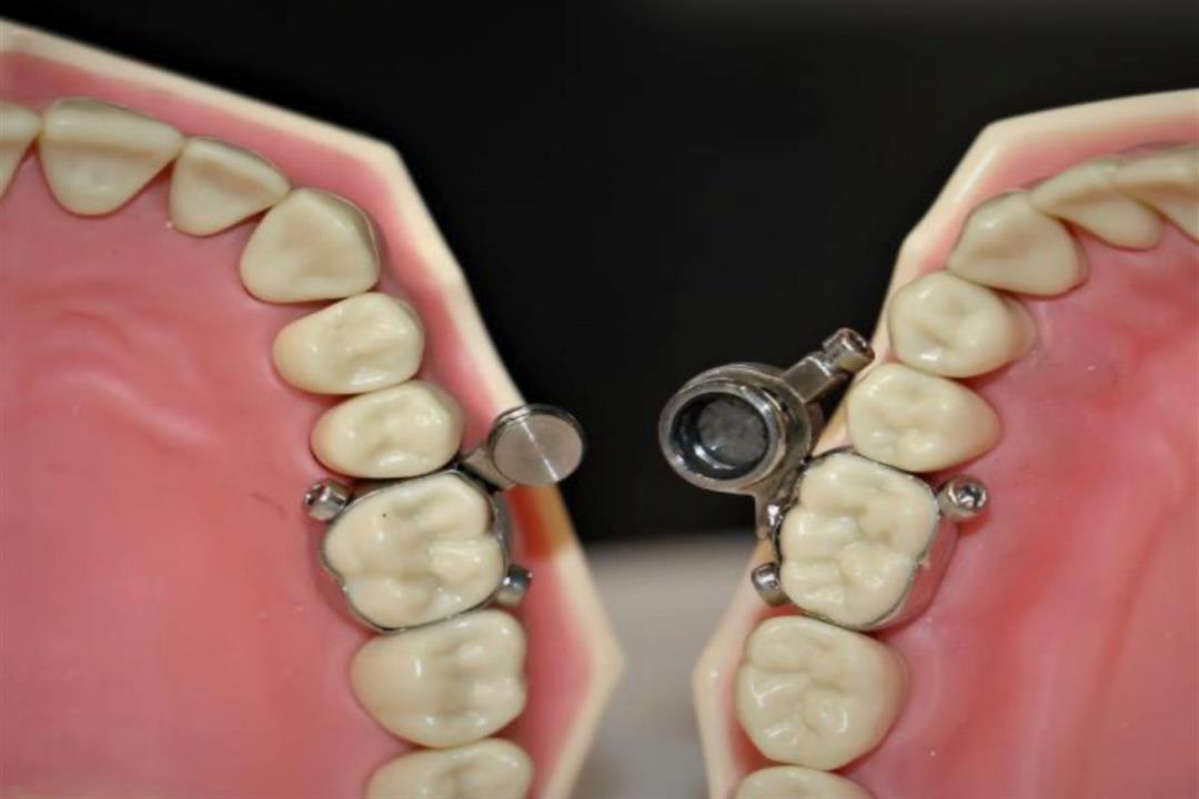 dentalslim-diet-control-weight-loss-device-developed-in-dunedin-locks-mouth-almost-shut-162483637522362