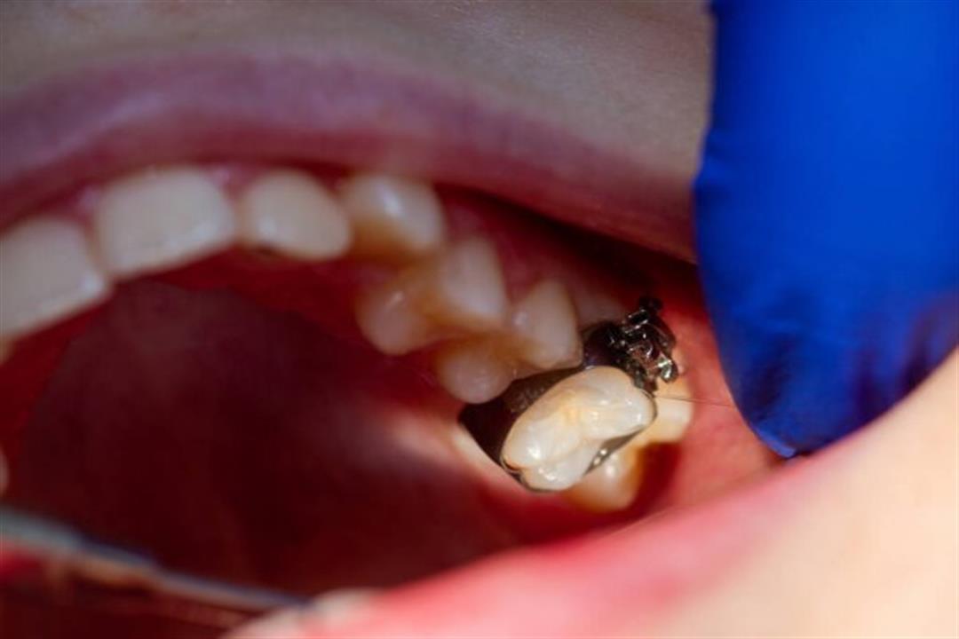 قفل الأسنان.. أحدث جهاز حول العالم لإنقاص الوزن (صور)