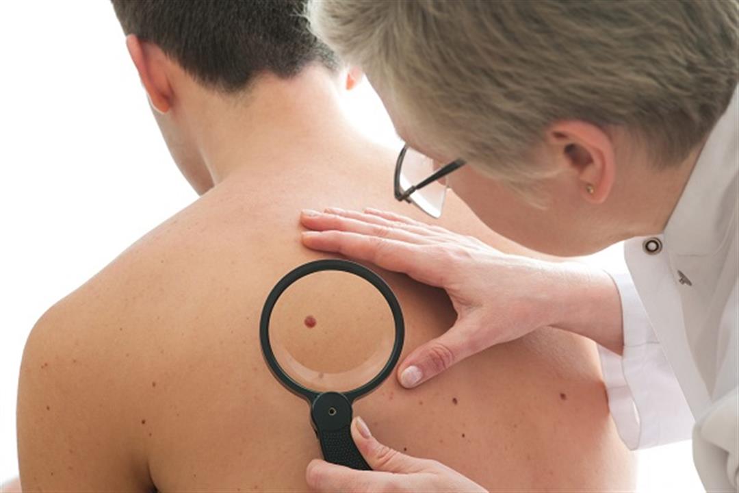 طبيبة تحذر الرجال: هذه العلامة قد تدل على الإصابة بسرطان الجلد