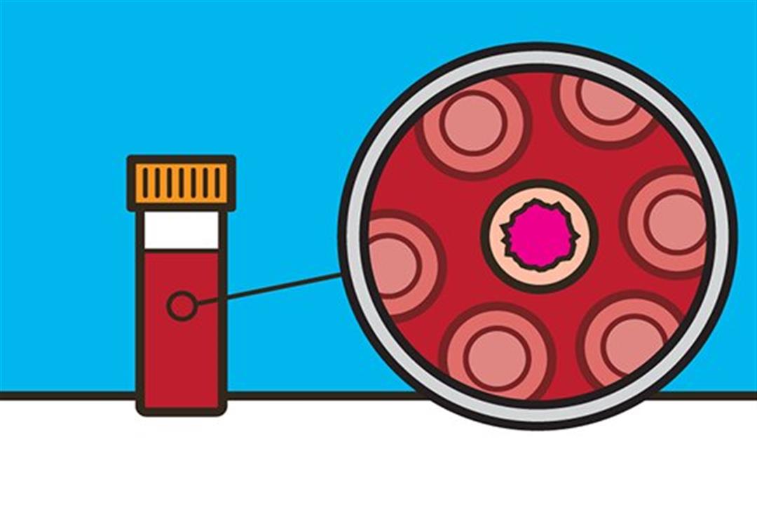 قبل ظهور الأعراض.. ابتكار اختبار دم يكشف 50 نوعًا من السرطان