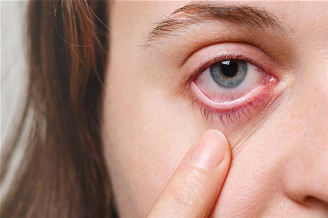 نزلات البرد.. كيف تؤثر على صحة العيون؟
