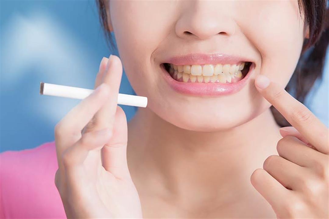 أضرار التدخين على الفم.. هذا ما يفعله بأسنانك ولثتك
